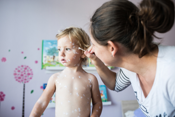 Little two year old girl at home sick with chickenpox, white antiseptic cream applied by her mother to the rash.