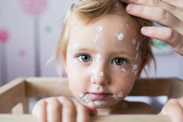 Face of little two year old girl at home sick with chickenpox, white antiseptic cream applied to the rash