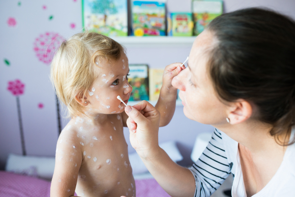 Little two year old girl at home sick with chickenpox, white antiseptic cream applied by her mother to the rash