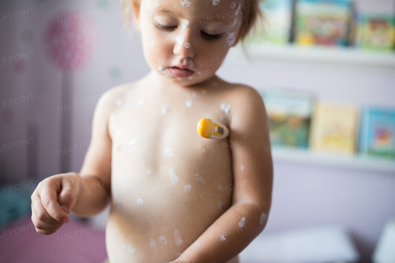 Little two year old girl at home sick with chickenpox, white antiseptic cream applied to the rash, measures the temperature with thermometer under her arm