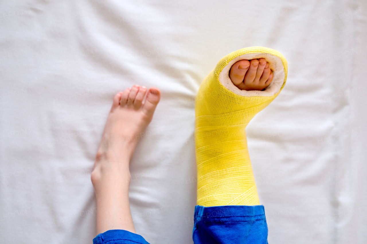 Broken leg in cast of unrecognizable little boy sitting on bed.