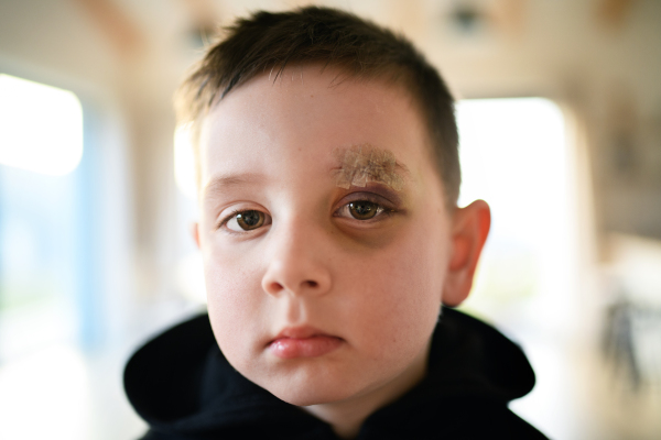 A poor sad small boy with cut eyebrow standing indoors at home, poverty concept.