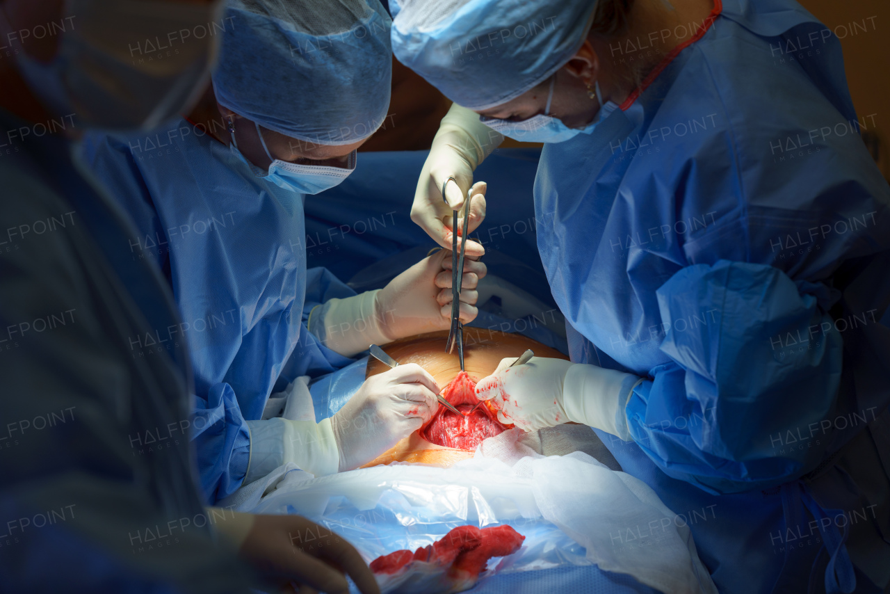 Abdominal surgery. Gynecologist, obstetricians and nurses as medical team during cesarean section delivery. Team of doctors performing surgery, operation. Modern Maternity hospital.