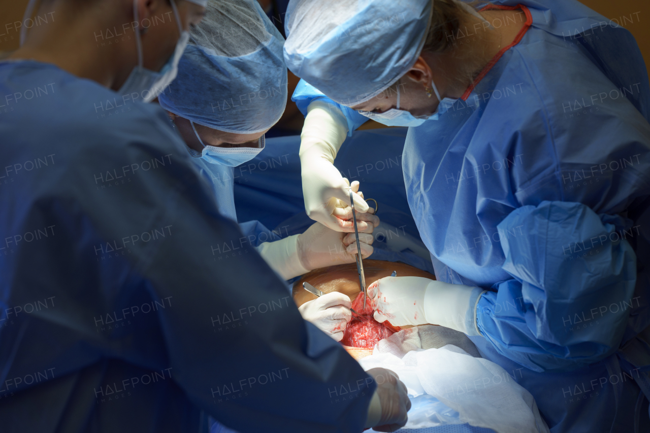 Abdominal surgery. Gynecologist, obstetricians and nurses as medical team during cesarean section delivery. Team of doctors performing surgery, operation. Modern Maternity hospital.