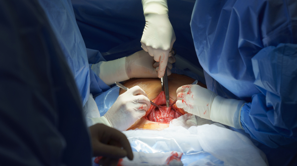 Gynecologist, obstetricians and nurses as medical team during cesarean section delivery. Team of doctors performing surgery, operation. Modern Maternity hospital.