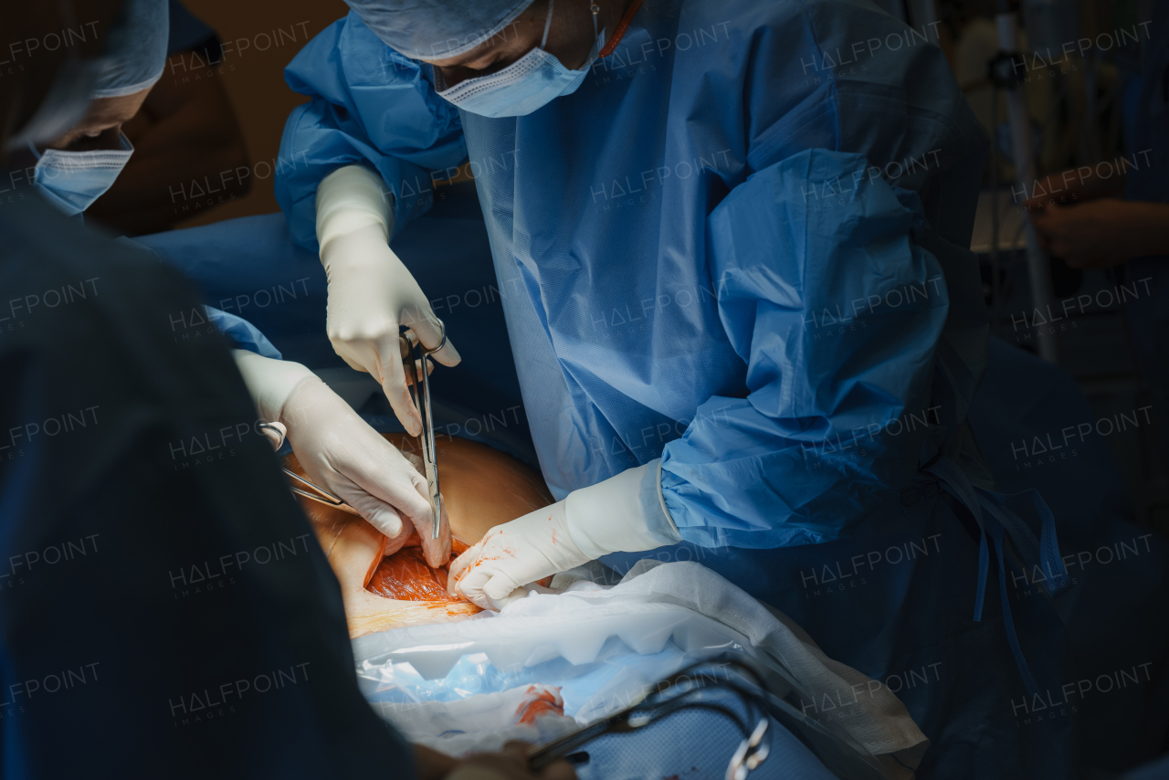 Abdominal surgery. Gynecologist, obstetricians and nurses as medical team during cesarean section delivery. Team of doctors performing surgery, operation. Modern Maternity hospital.