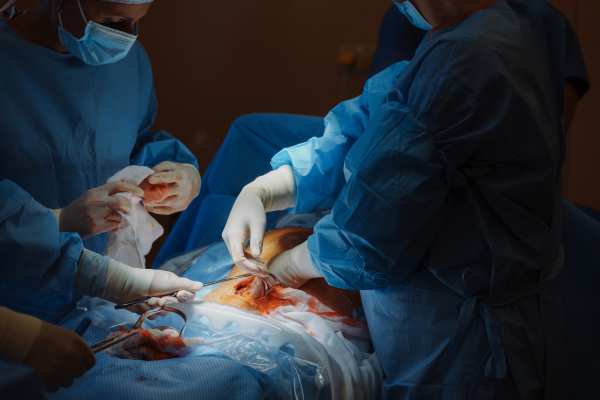 Abdominal surgery. Gynecologist, obstetricians and nurses as medical team during cesarean section delivery. Team of doctors performing surgery, operation. Modern Maternity hospital.