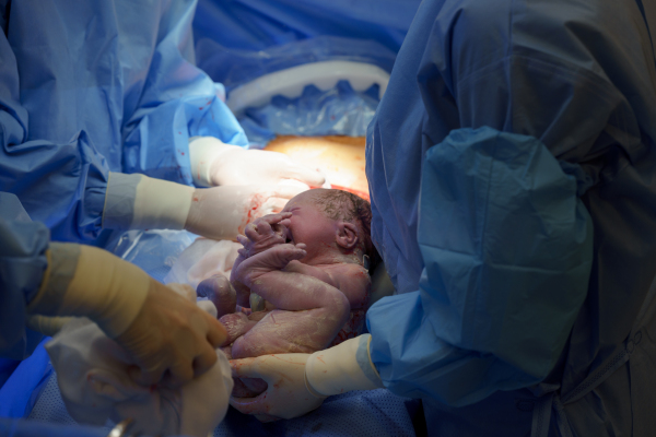 Delivery of baby by c-section. Gynecologist, obstetricians and nurses as medical team during cesarean childbirth. Team of doctors performing surgery, operation. Modern Maternity hospital.