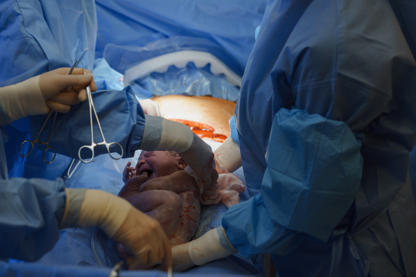 Delivery of baby by c-section. Gynecologist, obstetricians and nurses as medical team during cesarean childbirth. Team of doctors performing surgery, operation. Modern Maternity hospital.