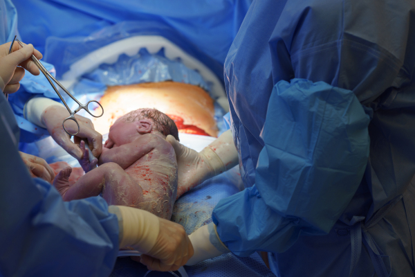 Delivery of baby by c-section. Gynecologist, obstetricians and nurses as medical team during cesarean childbirth. Team of doctors performing surgery, operation. Modern Maternity hospital.