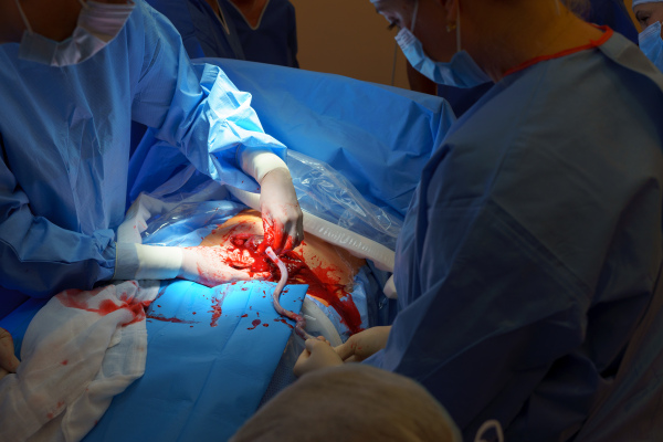 Delivery of of placenta after c-section childbrid. Gynecologist, obstetricians and nurses as medical team during cesarean section. Team of doctors performing surgery. Modern Maternity hospital.