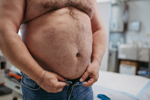 Close up of abdomen of overweight patient. High waist circumference of obese man. Concept of health risks of overwight and obesity.