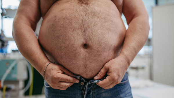 Close up of abdomen of overweight patient. High waist circumference of obese man. Concept of health risks of overwight and obesity.