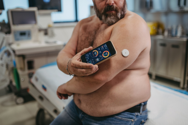 Patient connecting continuous glucose monitor with smartphone, to check his blood sugar level in real time. Obese, overweight man is at risk of developing type 2 diabetes. Concept of the health risks of overwight and obesity.