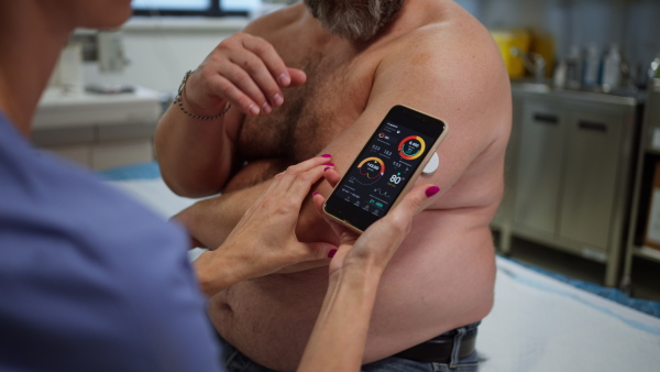 Doctor connecting patient's continuous glucose monitor with smartphone, to check his blood sugar level in real time. Obese, overweight man is at risk of developing type 2 diabetes. Concept of health risks of overwight and obesity.