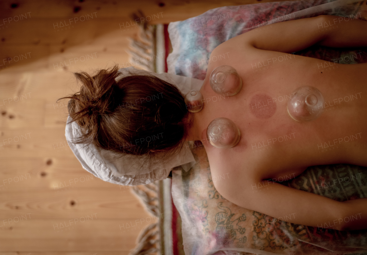 A high angle view of relaxed young woman receiving cupping treatment on back, traditional chinese medicine.