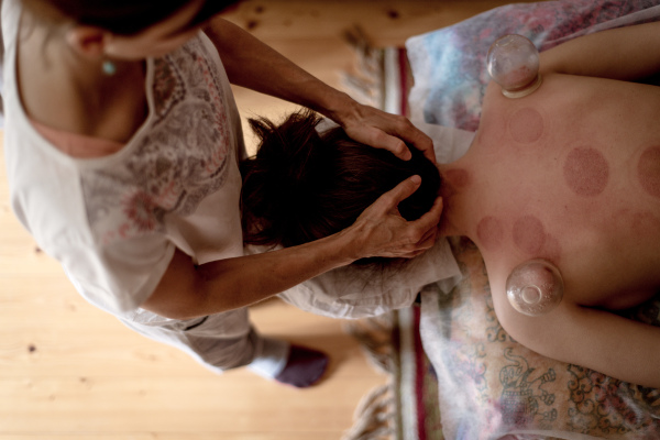 A high angle view of relaxed young woman receiving cupping treatment on back, traditional chinese medicine.