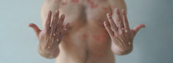 A male hands affected by blistering rash because of monkeypox or other viral infection on white background