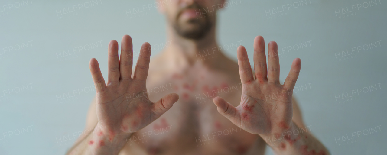 A male hands affected by blistering rash because of monkeypox or other viral infection on white background