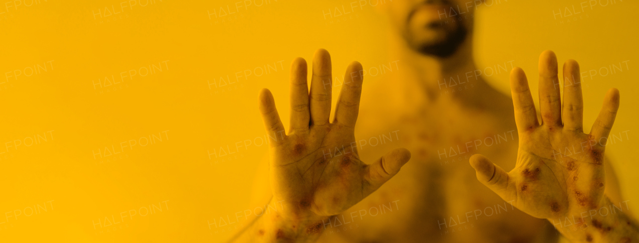 a Male hands affected by blistering rash because of monkeypox or other viral infection on yellow background, wide banner.