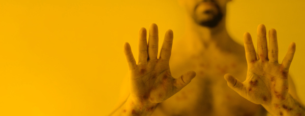 a Male hands affected by blistering rash because of monkeypox or other viral infection on yellow background, wide banner.