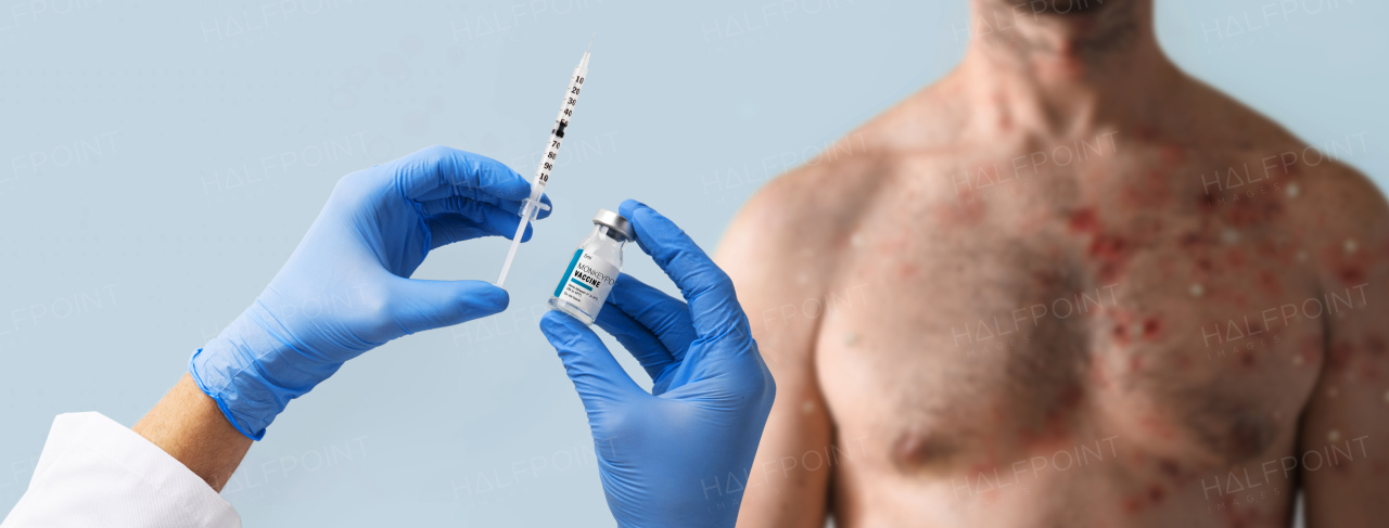 A doctor's hand holding monkeypox vaccine with male chest affected by blistering rash because of monkeypox in background.