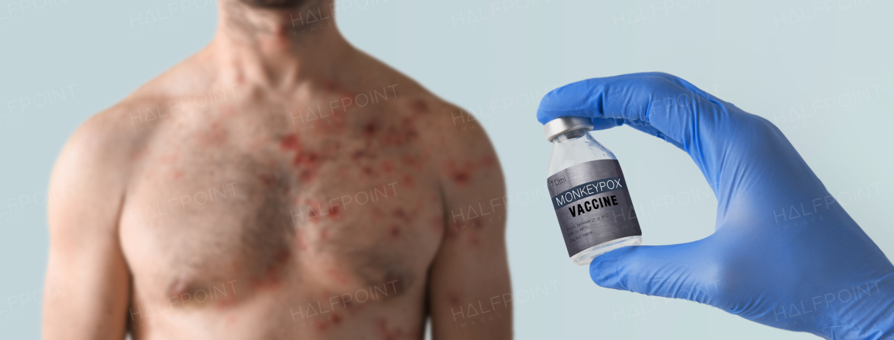 A doctor's hand holding monkeypox vaccine with male chest affected by blistering rash because of monkeypox in background.