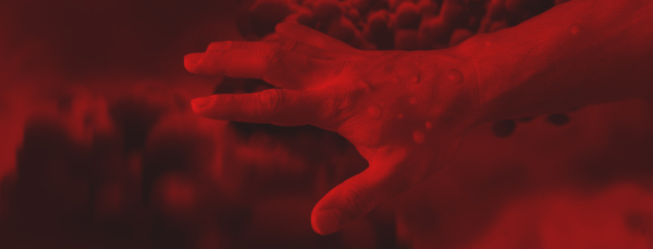 A male hands affected by blistering rash because of monkeypox infection on red background