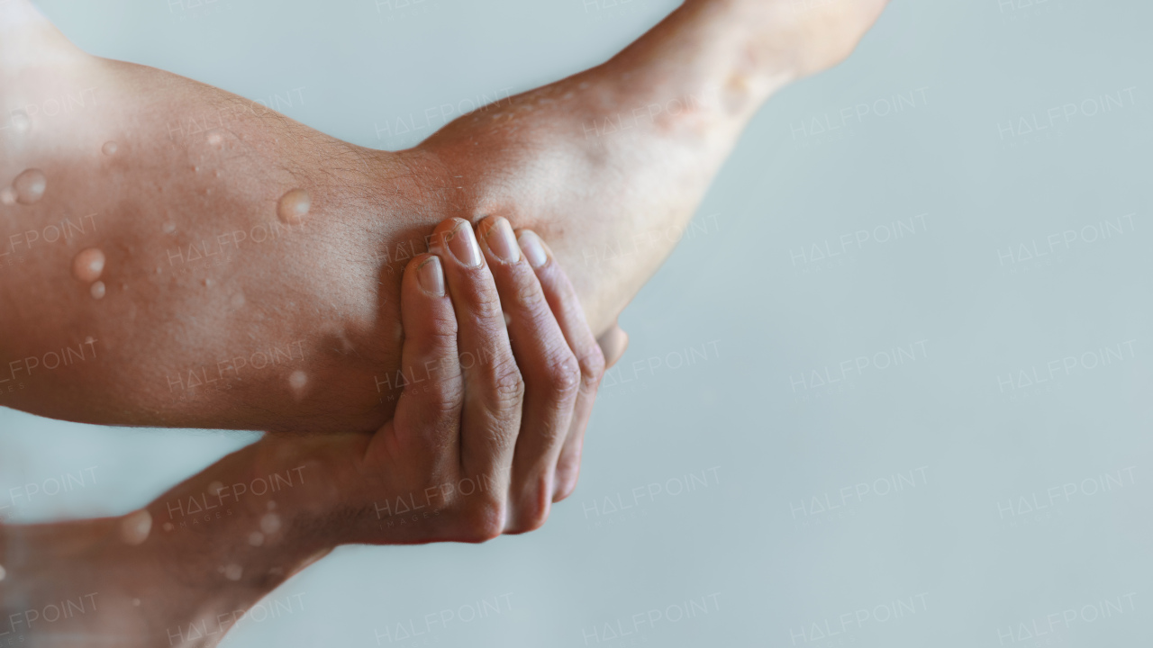 Male elbow affected by blistering rash because of monkeypox or other viral infection on white background