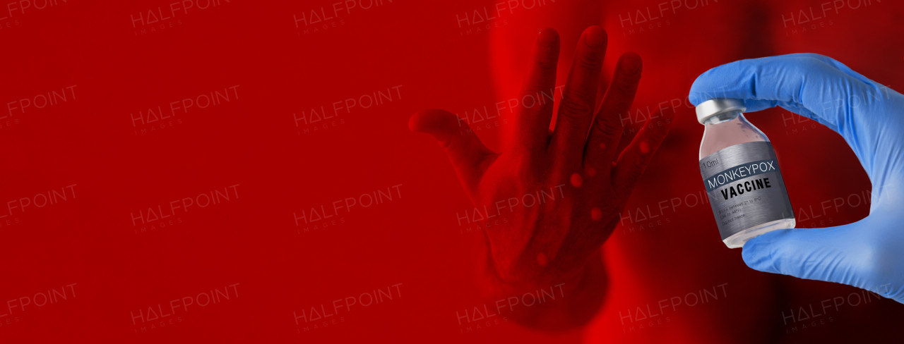 A doctor's hand holding monkeypox vaccine with male hand affected by blistering rash because of monkeypox on red background.