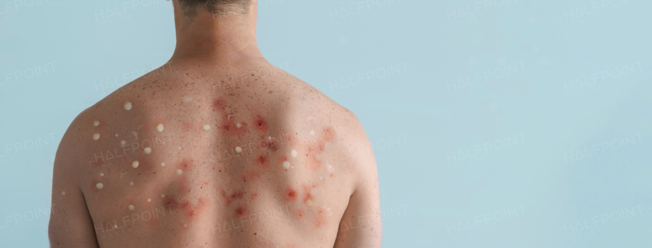 A male back affected by blistering rash because of monkeypox or other viral infection on white background