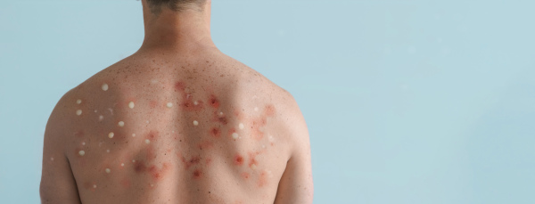 A male back affected by blistering rash because of monkeypox or other viral infection on white background