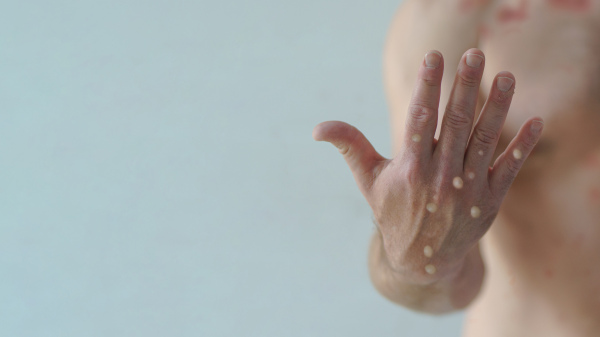 A male hands affected by blistering rash because of monkeypox or other viral infection on white background