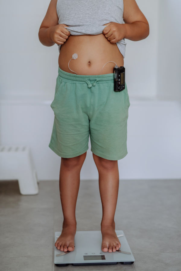 A young boy with diabetes weighing himself on bathroom scale. The need for weight control in pediatric diabetic patients. Boy using continuous glucose monitor.