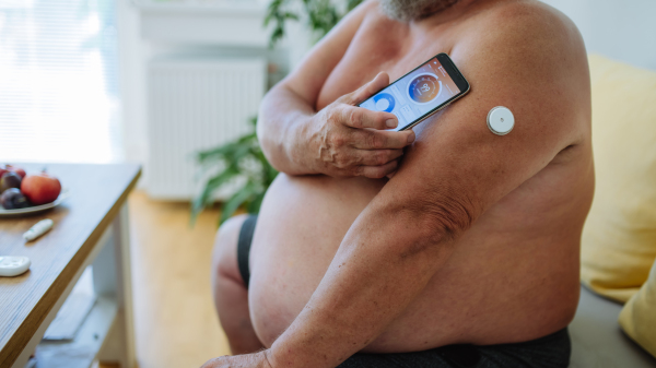 Overweight diabetic man connecting his CGM to a smartphone to monitor his blood sugar levels in real time. Close up of diabetic man using continuous glucose monitor to check blood sugar level.