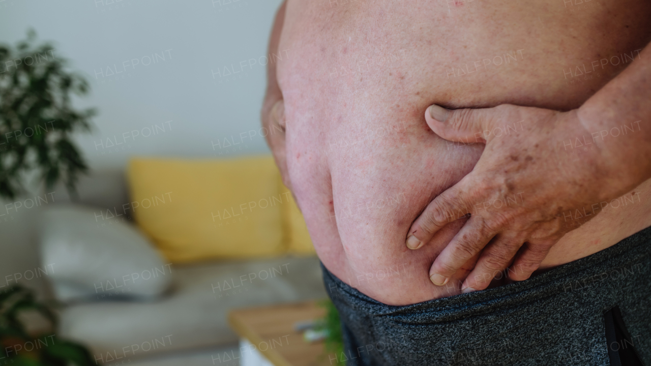 Close-up shot of an obese man holding his belly. Protruding obese abdomen, dangers of abdominal fat.