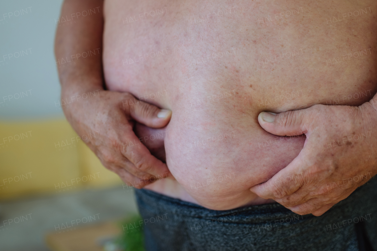 Close-up shot of an obese man holding his belly. Protruding obese abdomen, dangers of abdominal fat.