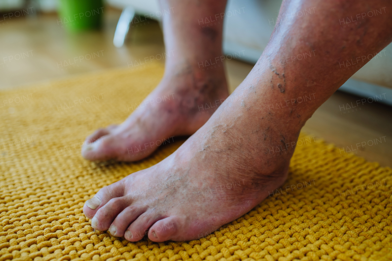 A close-up shot of man's feet with diabetic foot complications, showing his non-healing ulcers, skin discoloration and toe deformities.