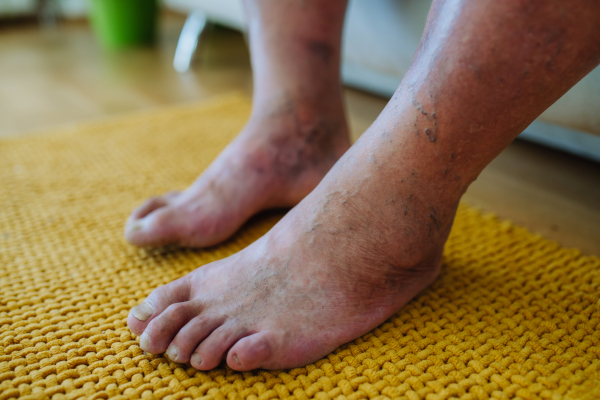 A close-up shot of man's feet with diabetic foot complications, showing his non-healing ulcers, skin discoloration and toe deformities.