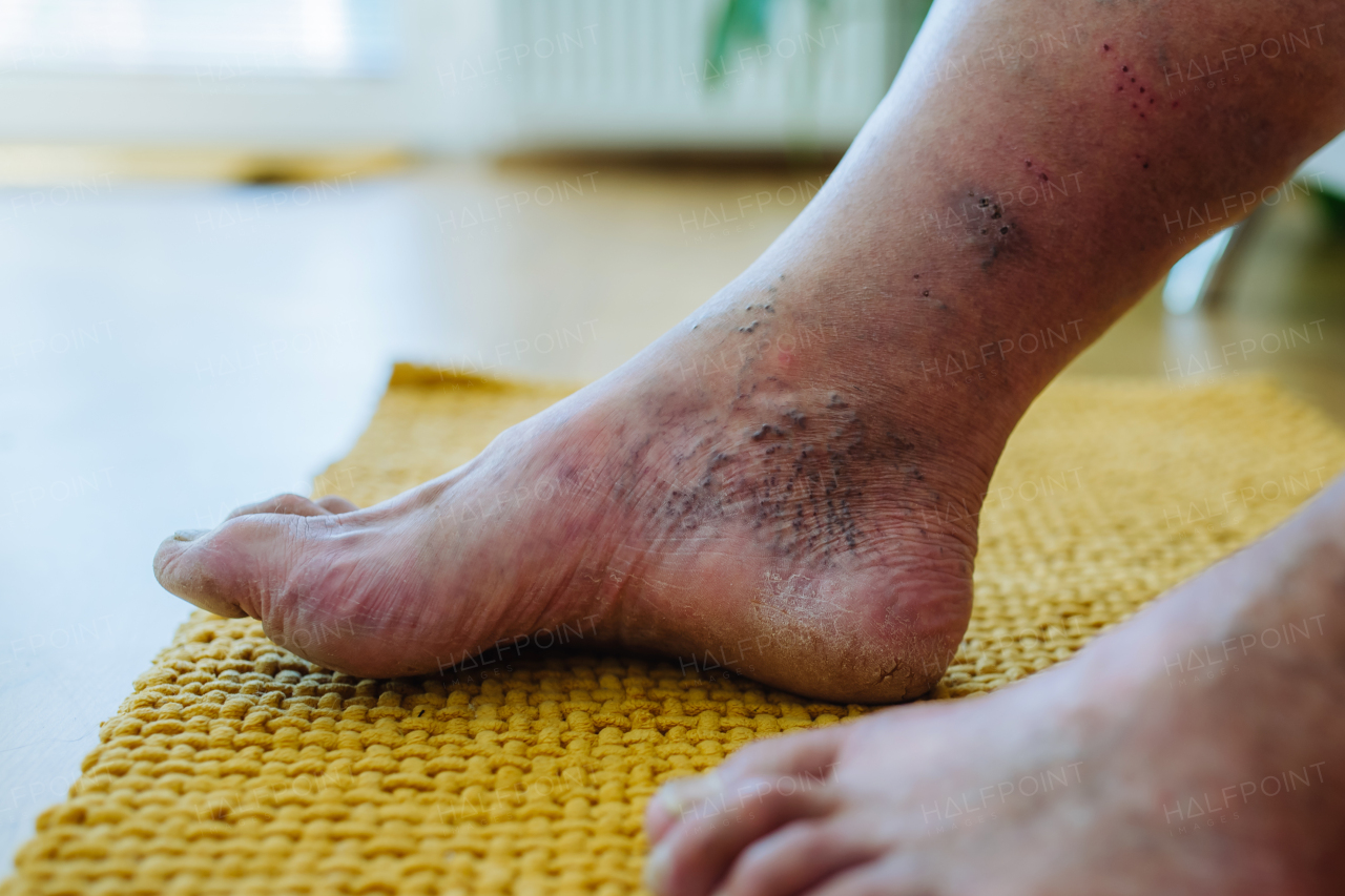 A close-up shot of man's feet with diabetic foot complications, showing his non-healing ulcers, skin discoloration and toe deformities.