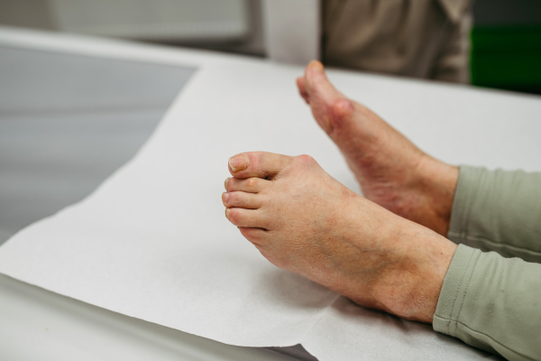Close-up of senior woman's feet with deformities.